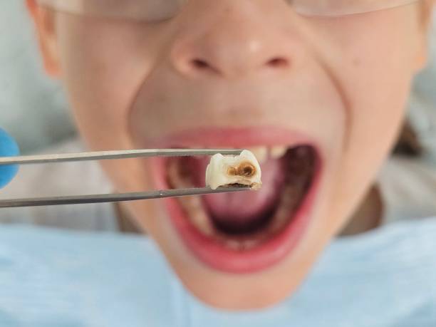 Best Emergency Treatment for Dental Infections or Abscesses in Third Lake, IL